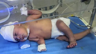 استئصال ورم يزن ٥ كيلو من رأس رضيع بمستشفى سوهاج الجامعي