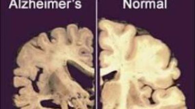 تدخين السجائر يزيد من مخاطر 