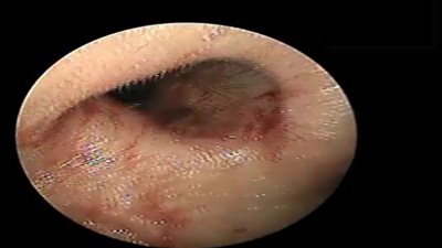 لقطات مقزز لطبيب يخرج دودة من أنف طفل (فيديو)