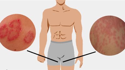 6 أسباب تؤدي إلى الإصابة بالسفعة الإربية