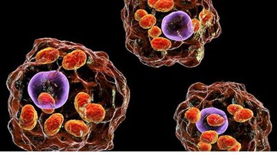 اللشمانيا.. أكثر الأمراض الجلدية انتشارا