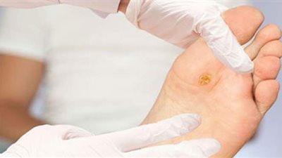 علاج القدم السكرى.. القسطرة أفضل الطرق وهذه علامات الخطورة