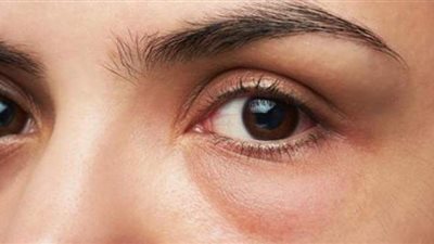 أفضل نصائح تساعدك في علاج انتفاخ العين