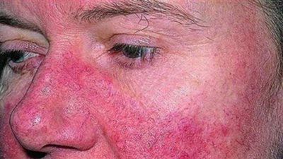 اعراض مرض الذئبة الحمراء وأسباب الإصابة وطرق العلاج