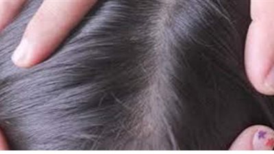 علاج القمل والصئبان.. 9 خطوات تريحك من المشاكل