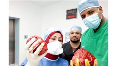 استئصال ورم ليفي يزن 4 كيلو من رحم سيدة أثناء ولادتها بمستشفى إسنا التخصصى