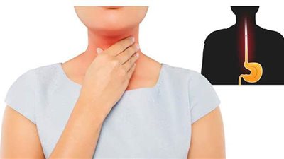 أعراض ارتجاع المريء وأفضل طرق الوقاية