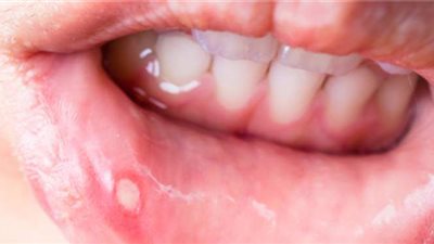 طرق التخلص من تقرحات الفم