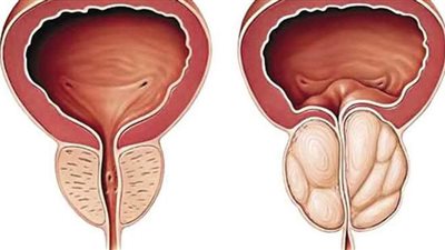 أعراض احتقان البروستاتا وأهم أسباب الإصابة بها