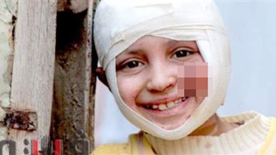 حرقت النيران وجهها.. حكاية الطفلة نورهان ضحية انفجار زجاجة بنزين بالدقهلية | فيديو وصور