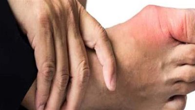 علاج النقرس نهائيا