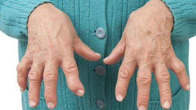 أعراض مرض الروماتويد