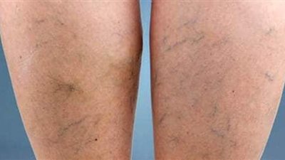 علاج دوالي الساقين