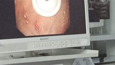 لأول مرة.. تركيب أنبوبة تغذية معدية لطفل عمره 7 سنوات بالمنظار بالتأمين الصحي الشامل