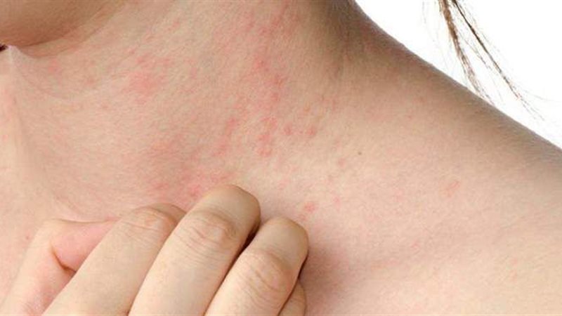 علاج الحساسية الجلدية