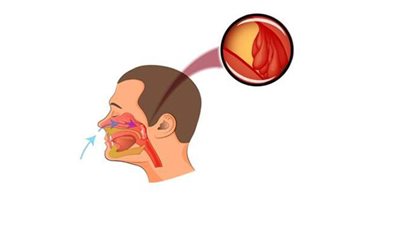 أعراض اللحمية وطرق العلاج