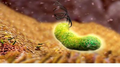 تعرف على أعراض الميكروب الحلزوني وطرق العلاج