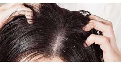 7 خطوات للتخلص من قشرة الشعر نهائيا