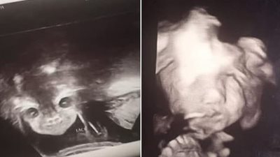 صور جنين في بطن والدته تثير ضجة.. ونشطاء: يشبه الشيطان