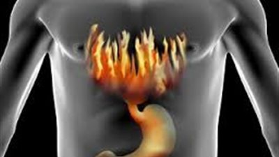 5 نصائح تساعد في علاج ارتجاع المريء