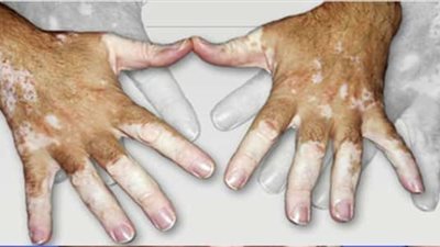 «البرص» من الأمراض الوراثية النادرة التي تصيب النظر والشعر والجلد