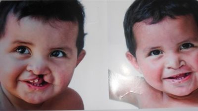 التشوهات الخلقية تهدد مواليد القليوبية.. التأمين الصحي: إنفاق 26 مليون جنيه على العمليات الجراحية.. المواطنون يطالبون المستشفيات بالتطوير وإدخال تقنيات الليزر