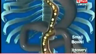 بالفيديو.. تحويل مسار «المعدة» للقضاء على السمنة والسكر