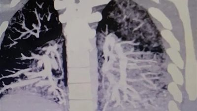 السجائر الإلكترونية تملأ رئة شاب بالزيت الصلب (صور)