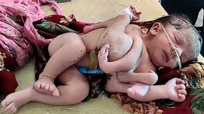 ولادة نادرة لطفلة بـ 4 أرجل و3 أياد في الهند (صور)