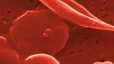 أنيميا فقر الدم سبب رئيسي في زيادة الوزن.. احذريها