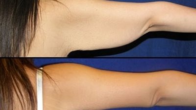 6 نصائح لشد ترهلات الجلد بعد انتهاء مدة الرجيم