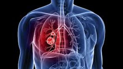 الصين تطلق منصة على الإنترنت للوقاية من سرطان الرئة