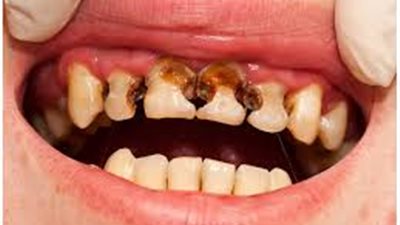الطرق الطبيعية والطبية لعلاج تسوس الأسنان
