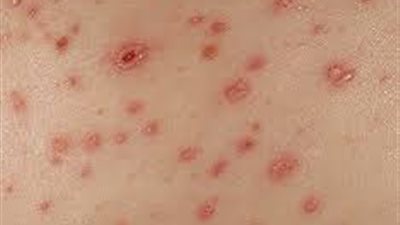 طرق وقاية أطفالك من الجديري المائي خلال الربيع