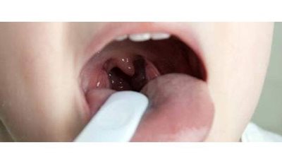 علاج التهاب الزور بالوصفات الطبيعية