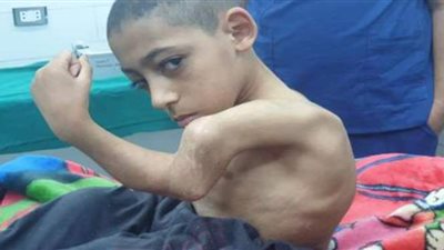 «الجراحة الأولى في مصر».. إجراء عملية نادرة داخل مستشفى بالمنيا لطفل مصاب بالعظم الزجاجي.. والطبيب يؤكد: المسمار النخاعي للذراعين كان الحل