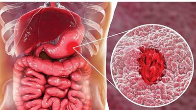 أعراض جرثومة المعدة وطرق العلاج والوقاية
