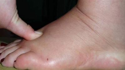 علاج الأملاح فى الجسم