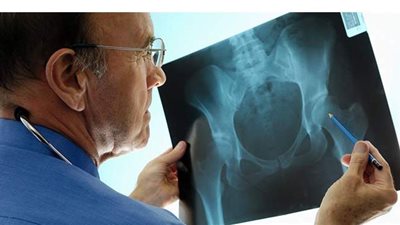 أعراض هشاشة العظام وأفضل النصائح لتجنب الإصابة