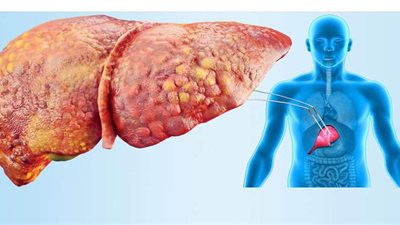 نظام غذائي لمدة يومين يضمن لك تنقية كبدك من كل السموم