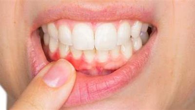 تعرف على علاج اللثة الملتهبة وأسبابها