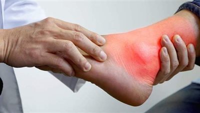 علاج النقرس نهائيا