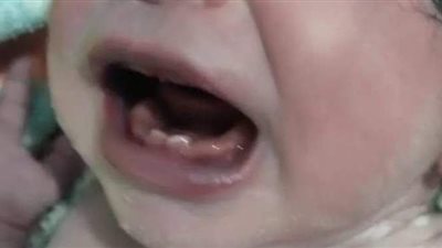 سيدة تضع مولوداً بأسنان في سوهاج | صور