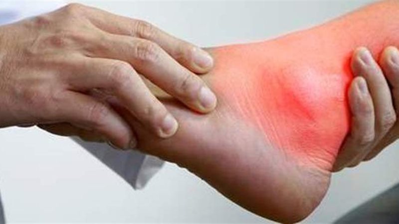 علاج النقرس