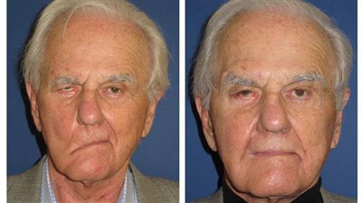 مرض العصب السابع.. الأسباب والأعراض والعلاج