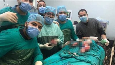استئصال توأم مسخي ملتصق لرضيعة في مستشفى جامعة المنيا