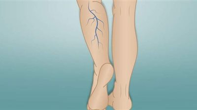 تعرف على علاج الدوالي وأهم الأعراض وأسباب الإصابة