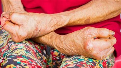 اليوم العالمي للجذام.. تنتقل العدوى عبر رذاذ الأنف والفم.. العمى وتشوه الوجه أبرز الأعراض.. وفترة الحضانة تصل إلى 20 عاما