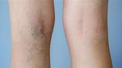 دوالي الساقين.. الأسباب والأعراض والعلاج