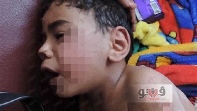 بالصور.. «أم» تطفئ السجائر في جسد ابنها بالقليوبية